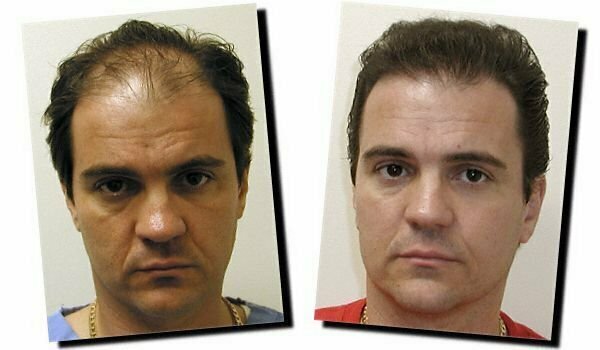 Hair Transplant in Dubai